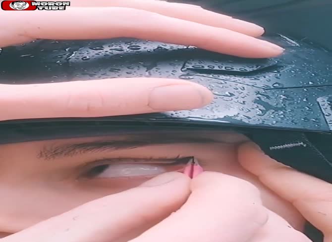 Video :A leech has been extracted from her eye